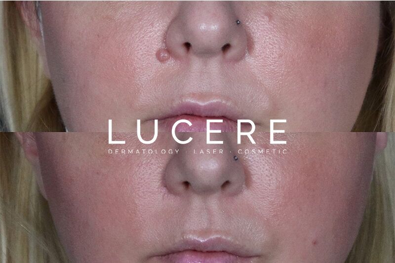 labial melanotic macule removal cost How Much Does Mole Removal Cost?